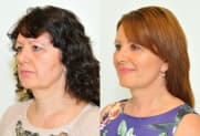 Facelift Galerie