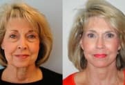 Facelift Galerie