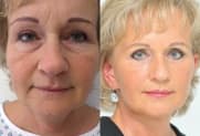 Facelift Galerie