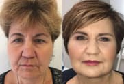 Facelift Galerie