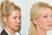 Facelift Galerie