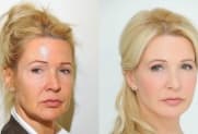 Facelift Galerie
