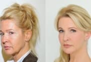 Facelift Galerie