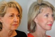 Facelift Galerie