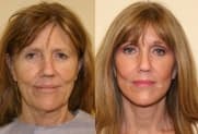 Facelift Galerie