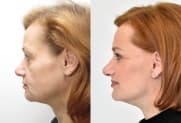 Facelift Galerie