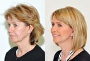 Facelift Galerie