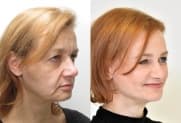 Facelift Galerie
