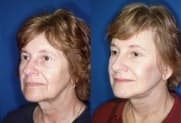 Facelift Galerie
