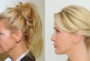 Facelift Galerie