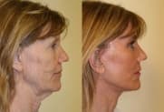 Facelift Galerie