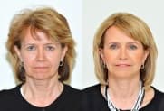 Facelift Galerie