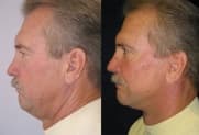 Facelift Galerie