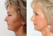 Facelift Galerie