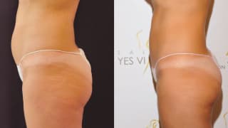 Foto – Laser-Fettabsaugung SlimLipo, Kryolipolyse – Ivana