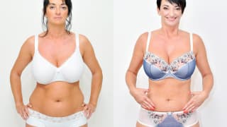 Foto – Laser-Fettabsaugung SlimLipo – Juliana