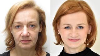 Foto – Facelift – Jitka