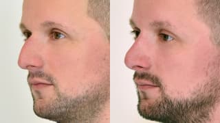 Foto – Rhinoplastik/Nasenkorrektur – Jakub