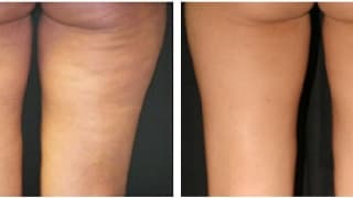 Cellulite-Entfernung