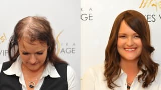 Foto – Lösung für dünnes Haar und Glatze – Zuzana