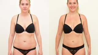 Foto – Laser-Fettabsaugung SlimLipo – Tereza