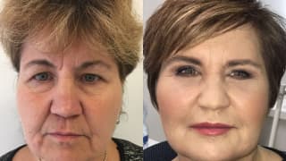 Foto – Facelift - Renata