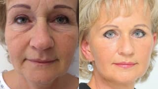 Foto – Facelift – Hana