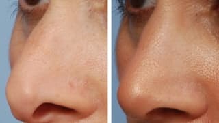 Rhinoplastik