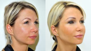 Foto – Contouring – Michaela