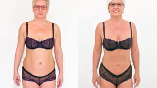 Foto – Laser-Fettabsaugung SlimLipo – Zdena