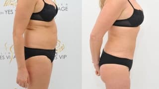 Fettabsaugung SlimLipo