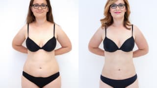 Foto – Laser-Fettabsaugung SlimLipo – Eva