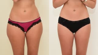 Foto – Laser-Fettabsaugung SlimLipo – Martina