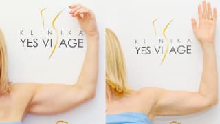 Foto – Laser-Fettabsaugung SlimLipo – Monika