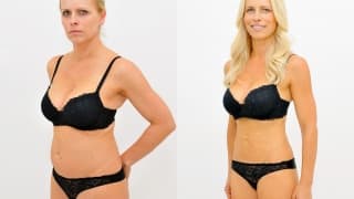 Foto – Laser-Fettabsaugung SlimLipo – Jana