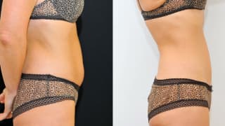 Foto – Laser-Fettabsaugung SlimLipo, Kryolipolyse – Jolana