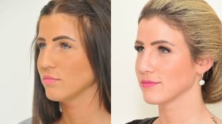 Foto – Rhinoplastik/Nasenkorrektur – Denisa