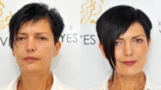 Foto – YES-Fadenlifting, Füllungen – Michaela
