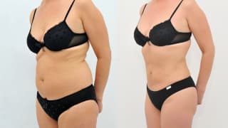 Foto – Laser-Fettabsaugung SlimLipo – Emilia