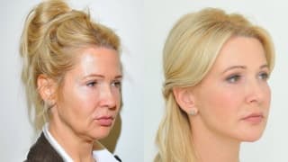 Foto – YES-Fadenlifting, Facelift – Lenka
