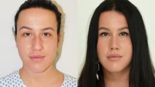 Foto – Rhinoplastik/Nasenkorrektur - Kristína