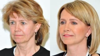 Foto – Facelift – Zdena