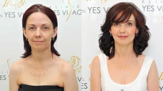 Foto – YES-Fadenlifting, Haare – Jolana