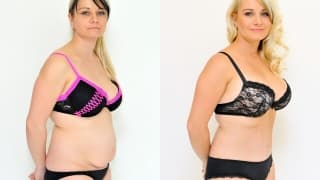 Foto – Abdominoplastik – Jarmila