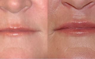 Botulinumtoxin