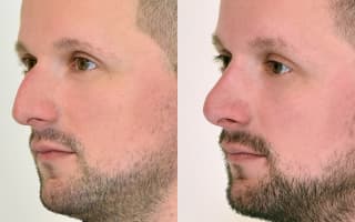 Rhinoplastik
