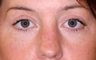 Augenringe und Tränensack