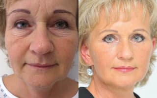 Facelift