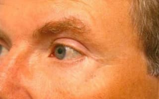 Augenringe und Tränensack