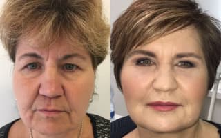 Facelift